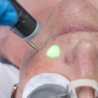 Laser Pigmentation & Vascular Vein Removal - Ealing
