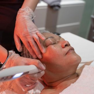 Micro-Needling with EPN Lynton - Ealing