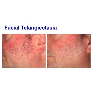 Vascular Lesion Removal - Large Area - Ealing