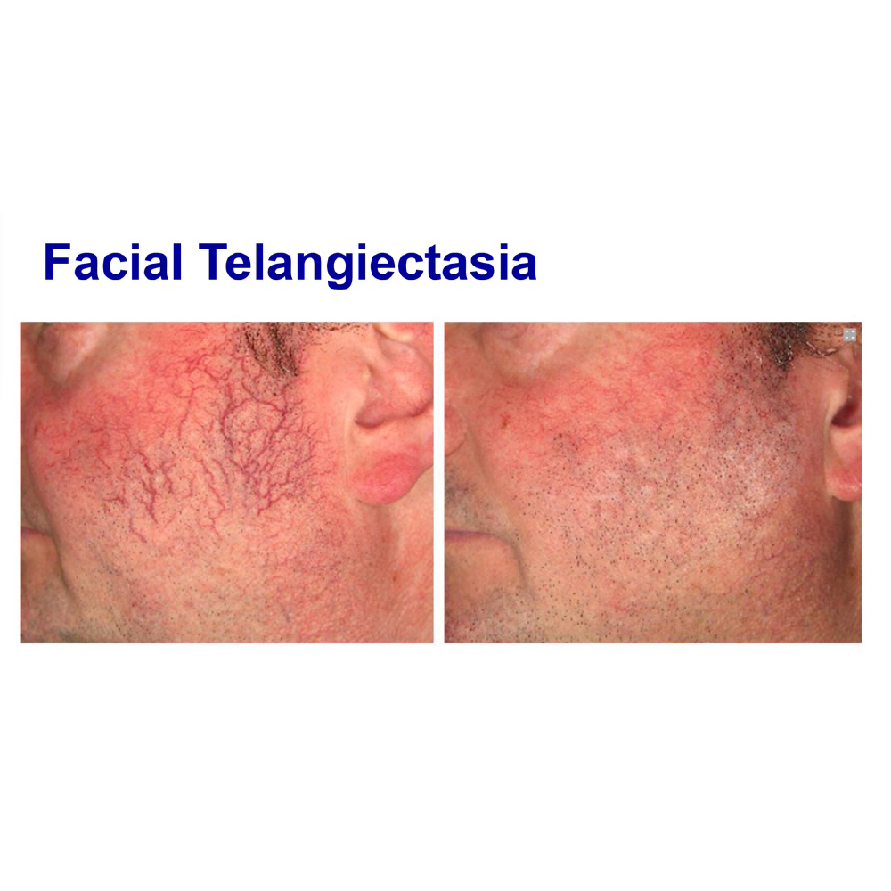 Vascular Lesion Removal - Large Area - Ealing
